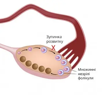 what-is-pcos-2-ua